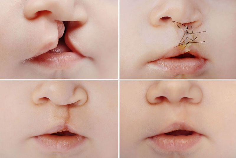 cleft lip surgery newborns