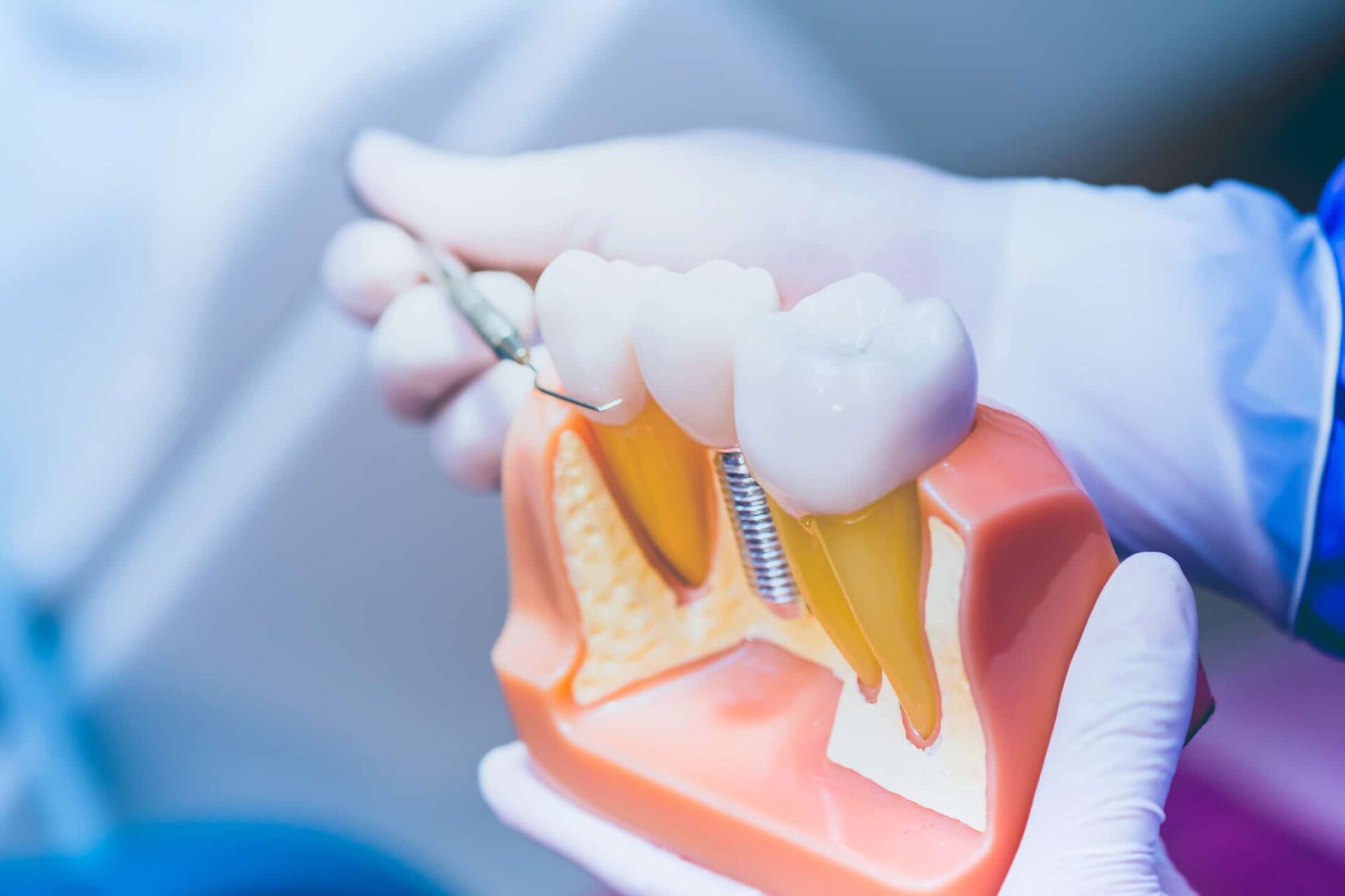 dental-implants-benefits-