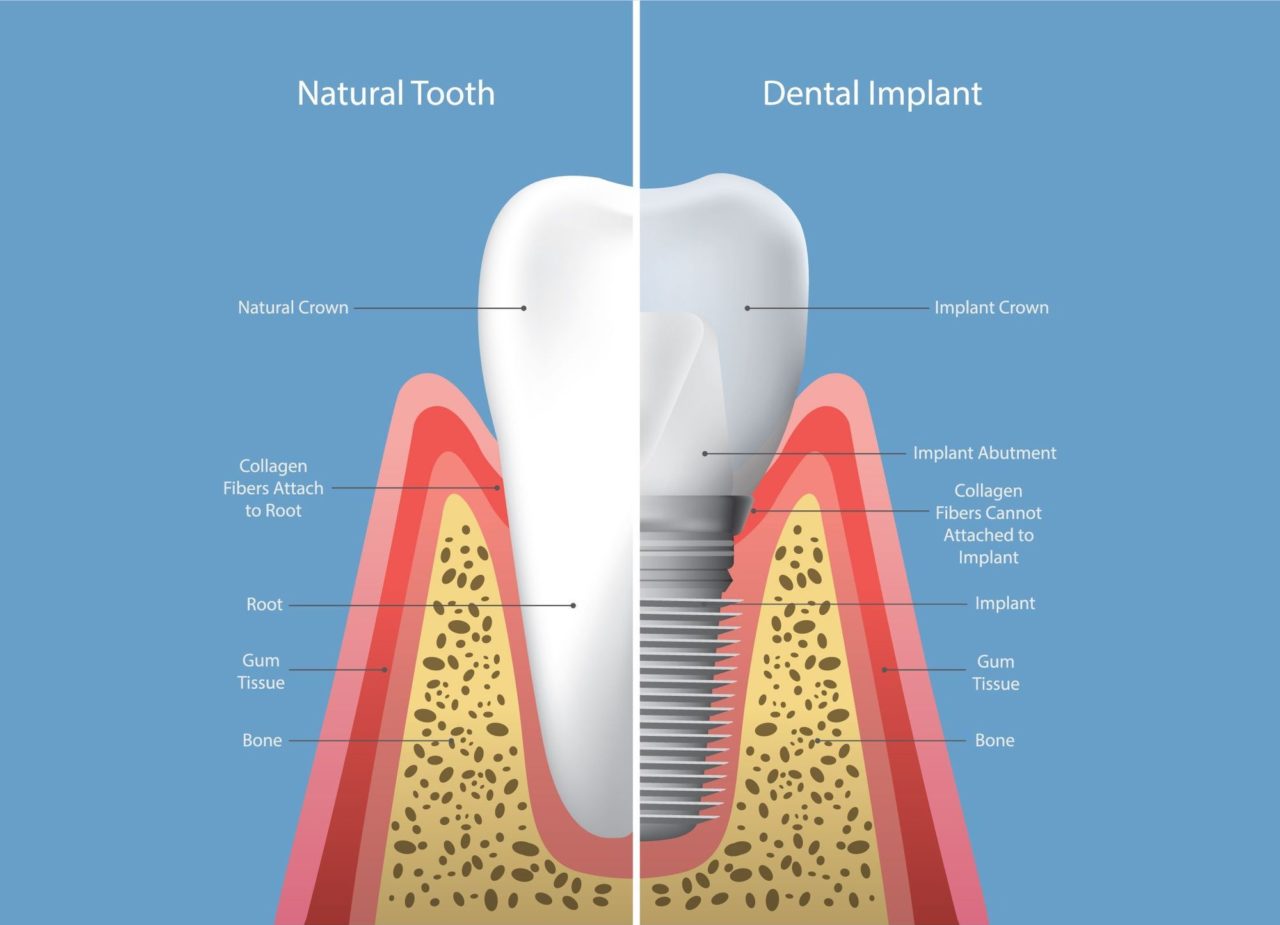Dental Implants Knoxville Oral & Maxillofacial Surgery