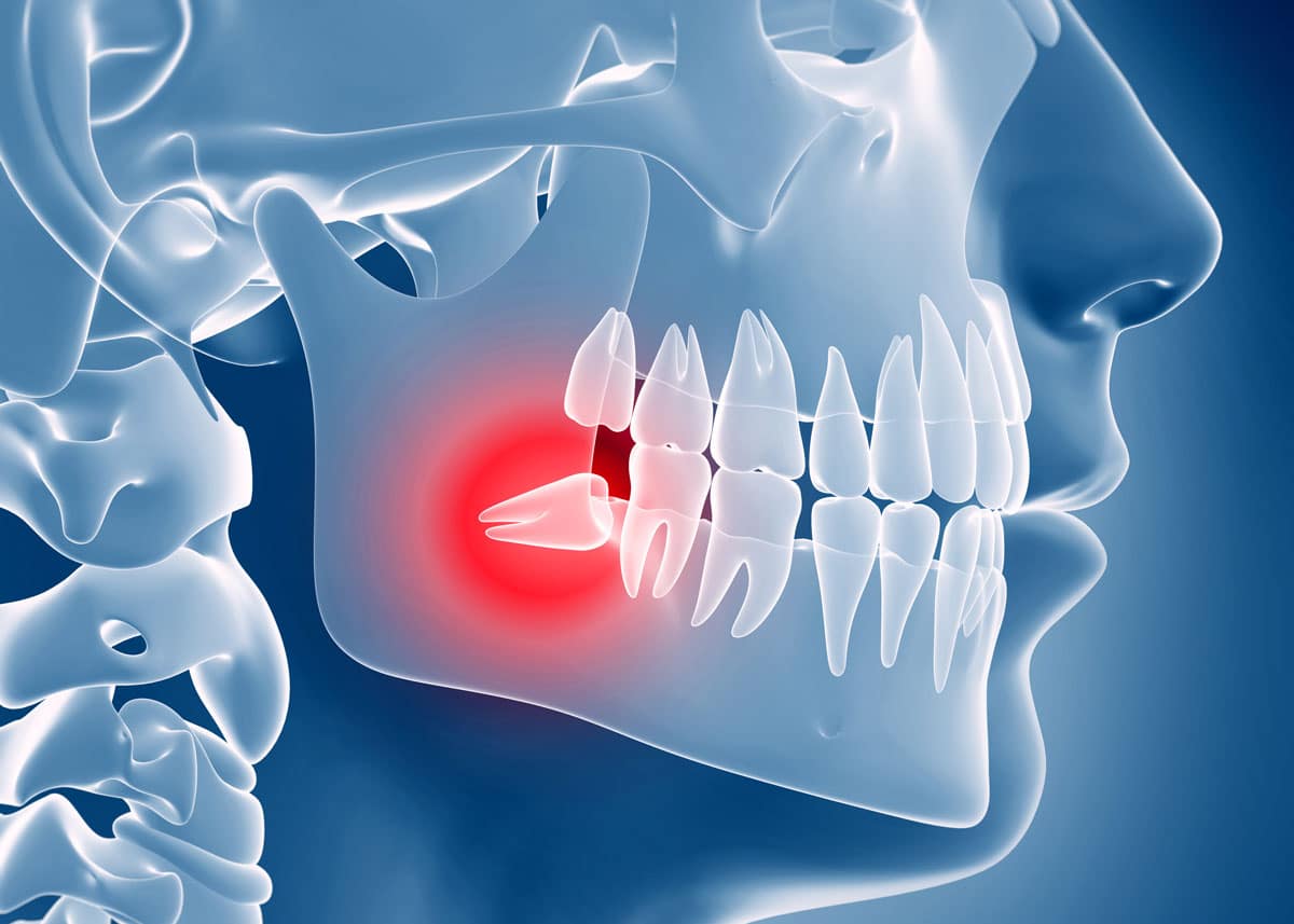 pain free wisdom tooth removal
