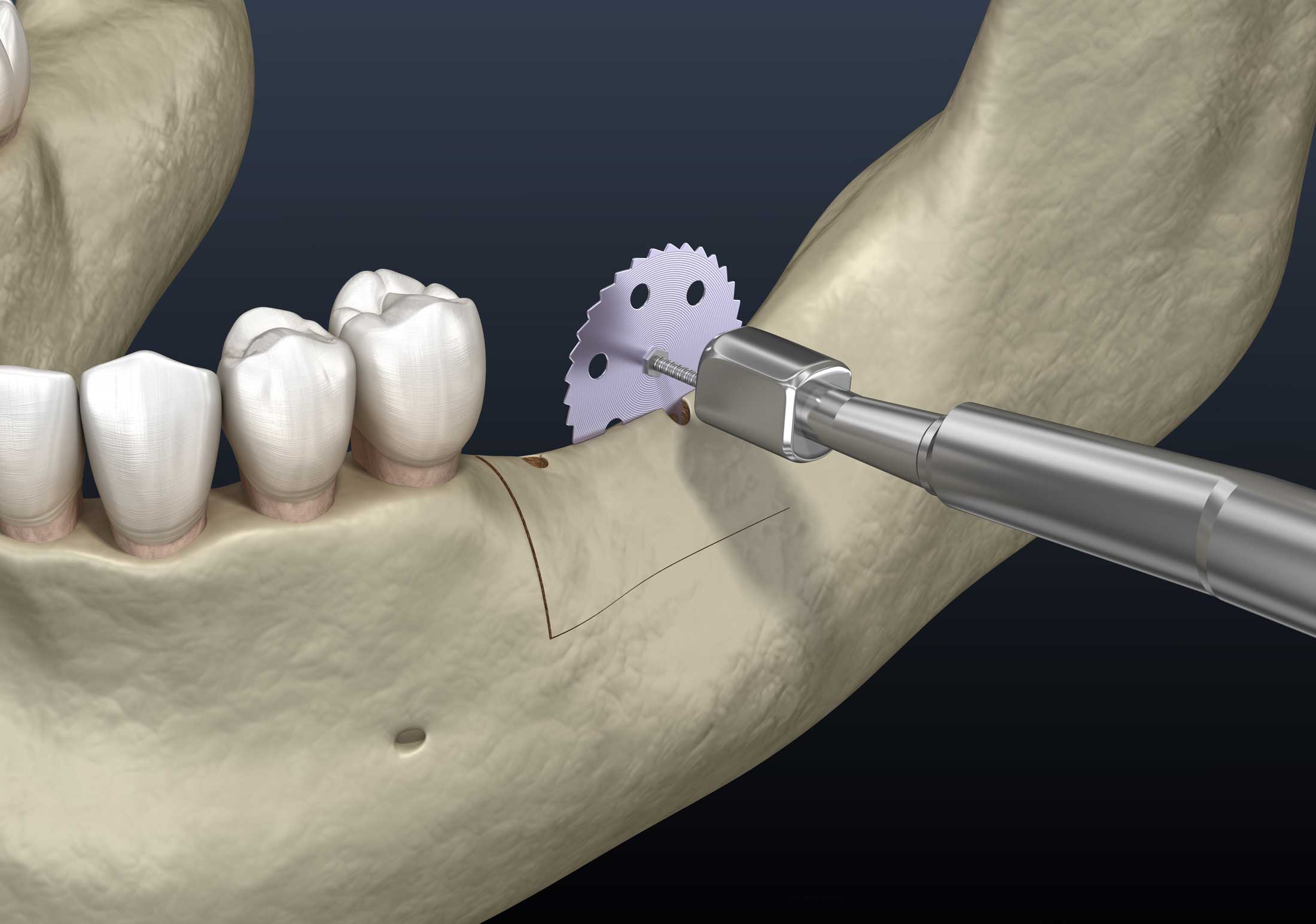 Ridge Augmentation Knoxville Oral & Maxillofacial Surgery