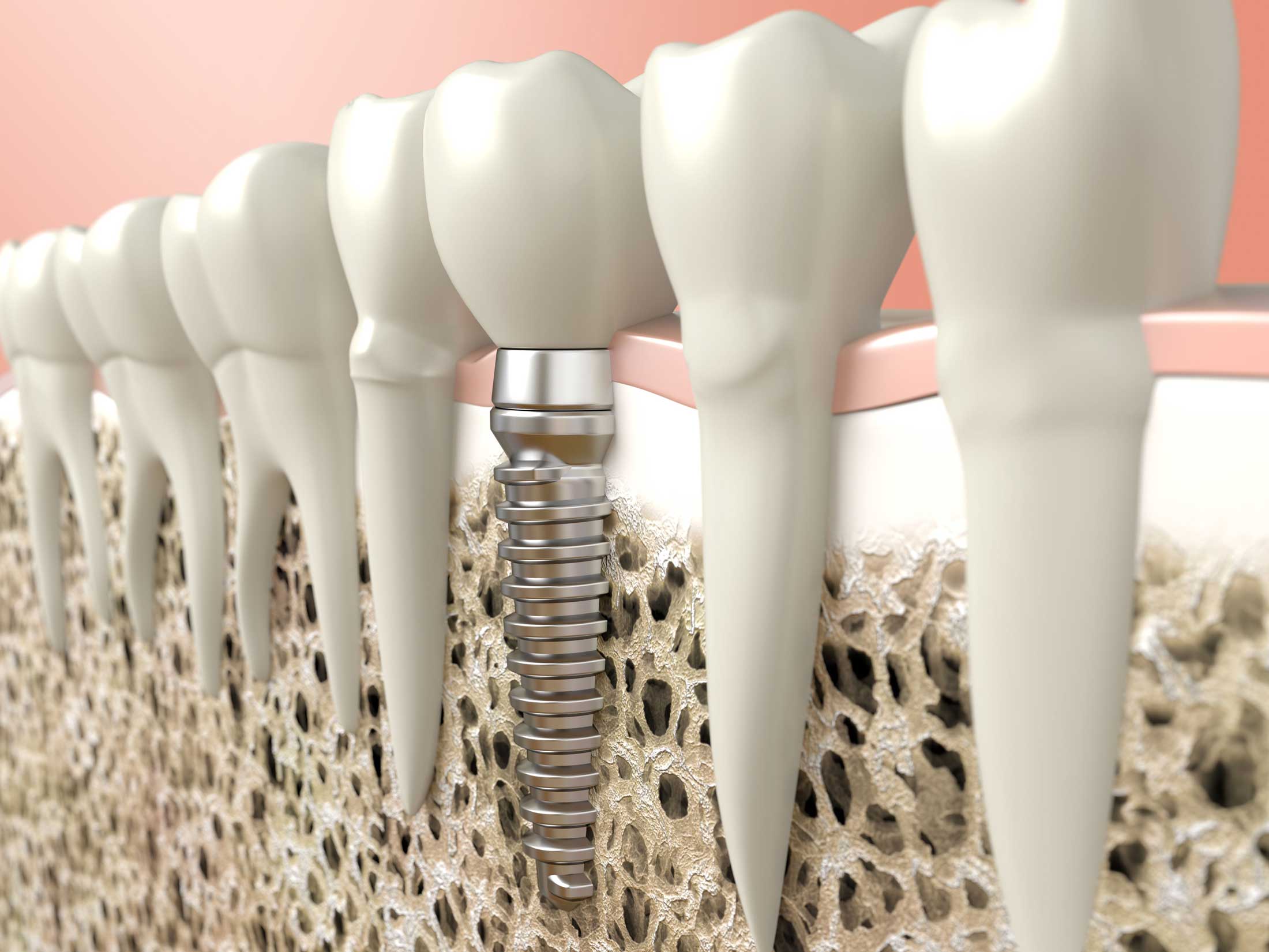 safe and effective dental implants web