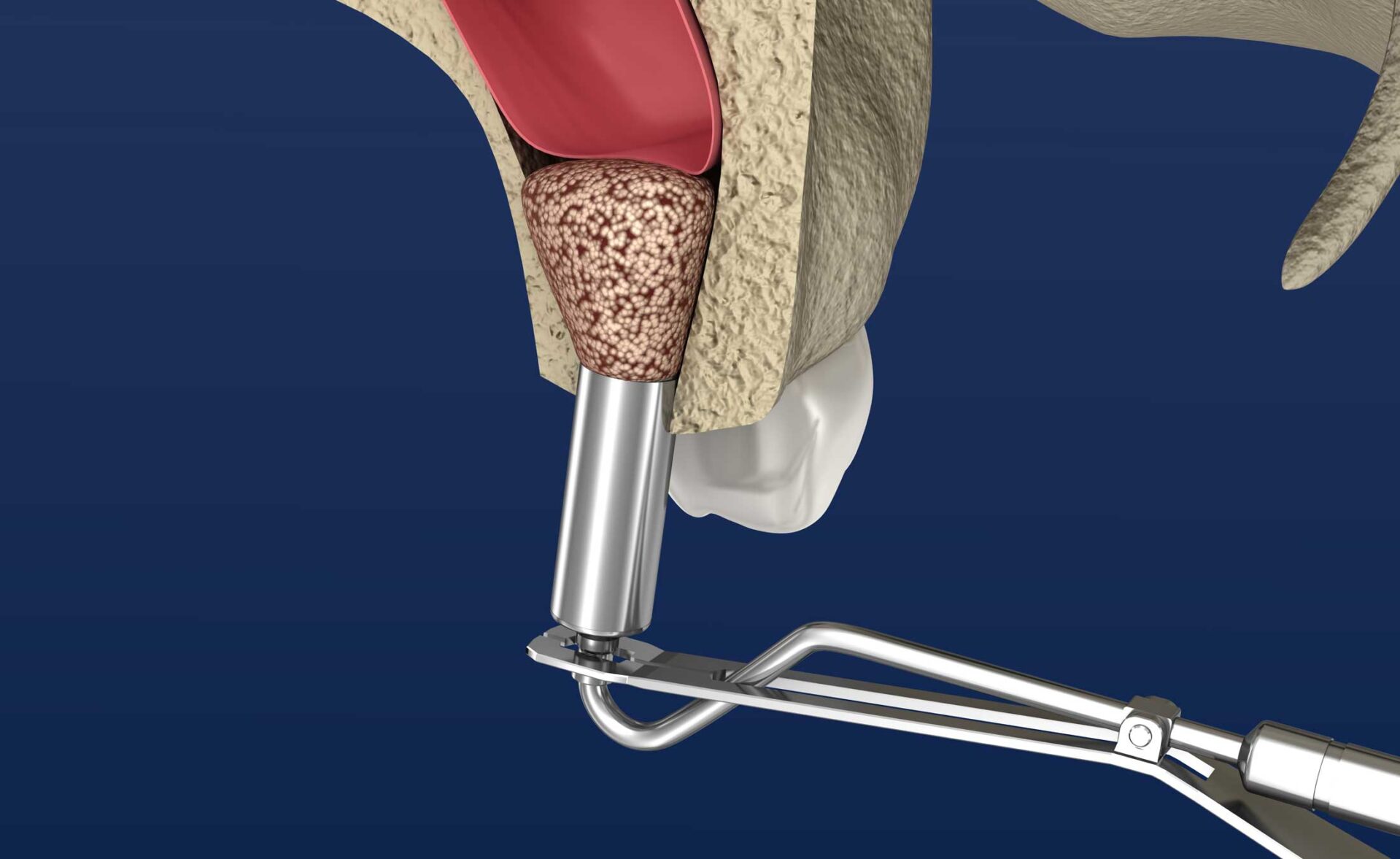 裁断済 上顎洞底挙上術のすべて Perfect Sinus Lift 裁断済 上顎洞底挙