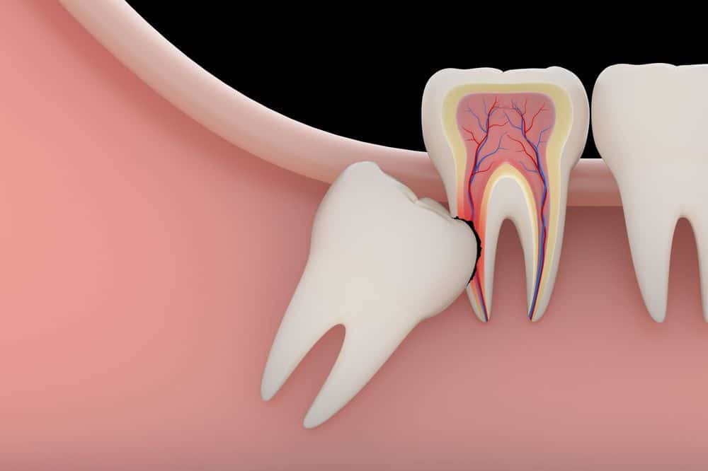 wisdom tooth preventative removal
