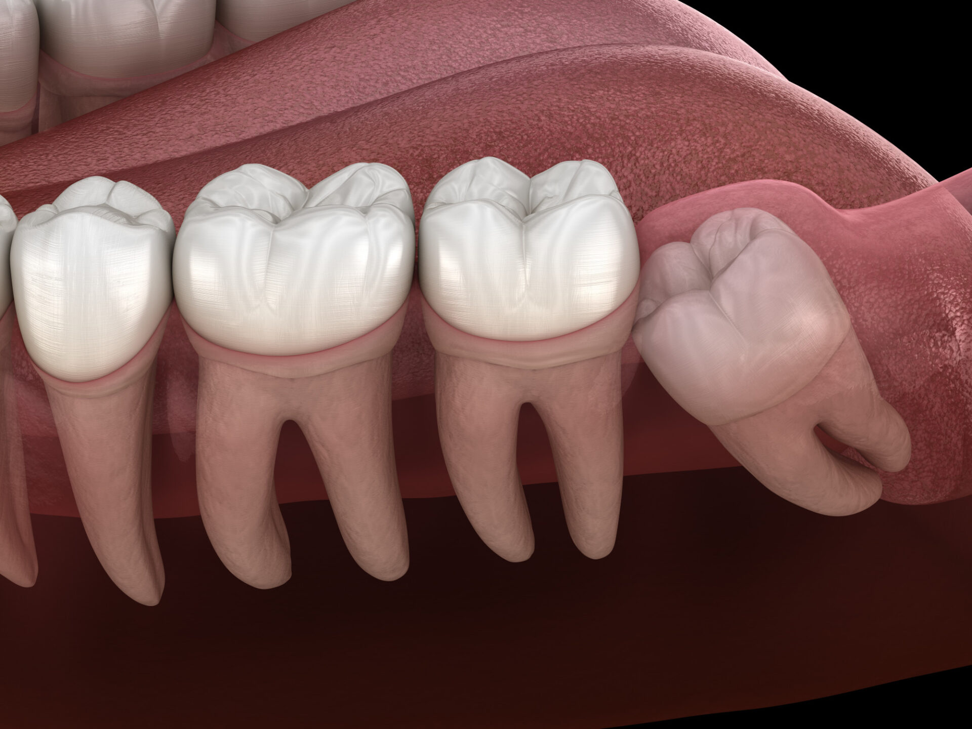 Does Wisdom Tooth Removal Hurt Reddit