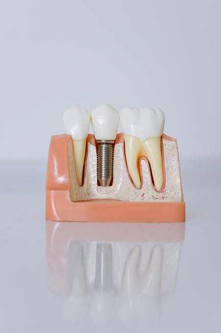 dental implant surgery in knoxville, tn